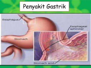 gastrik-101029042906-phpapp01-thumbnail-4