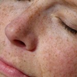 Contoh kulit Hyper-pigmentation