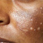 Hypo-pigmentation