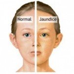 Perbezaan kulit normal dengan kulit jaundice