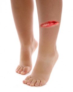 Contoh luka di kaki arwah Ani.. Malah lebih teruk drpd ni..