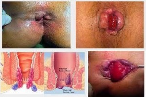Buasir sering dialami oleh lelaki tetapi amat kerap dialami oleh wanita selepas bersalim..