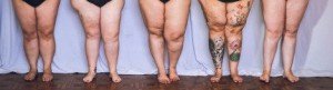 Ini akan dialami wanita hamil dan obesiti. Lemak berkumpul di bahagian paha nampak tak cantik dan susah nak dapat thigh gap..