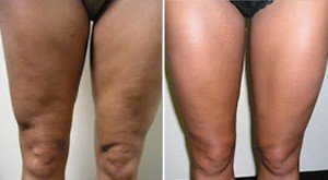Contoh kaki berselulit.. 
