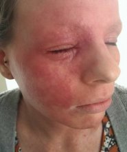 Psoriasis..